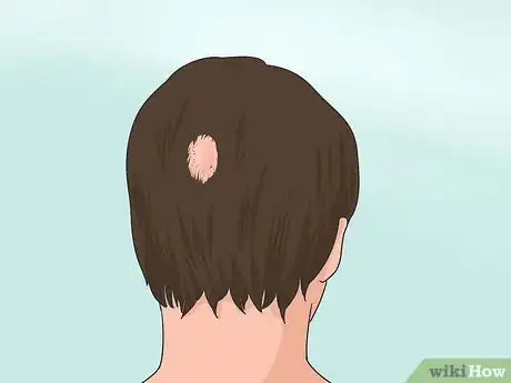 Image titled Stop Teen Hair Loss Step 6