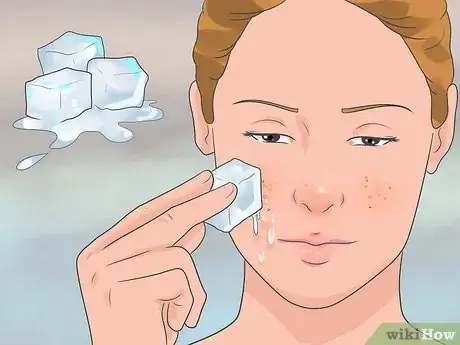 Image titled Heal a Pimple Step 11