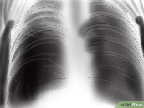 Image titled Recognize the Signs and Symptoms of Tuberculosis Step 13
