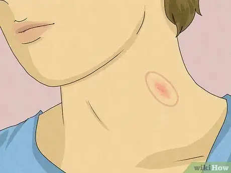 Image titled Identify a Hickey Step 2
