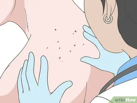 Image titled Remove Warts Naturally Step 15