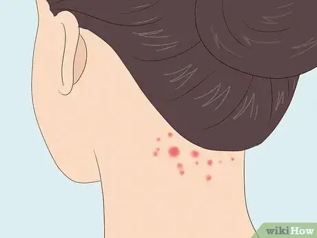 Image titled Identify Insect Bites Step 9