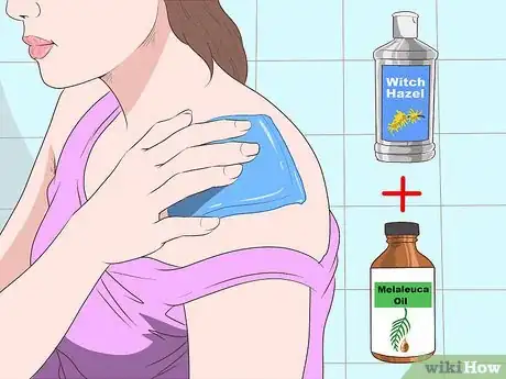 Image titled Stop Mosquito Bites from Itching Step 16