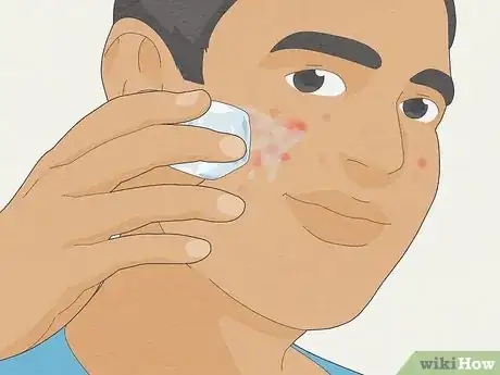 Image titled Get Rid of a Pimple Step 5