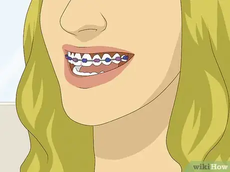 Image titled Look Great With Braces Step 2
