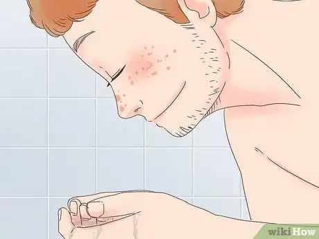 Image titled Remove the Redness of a Pimple Step 15