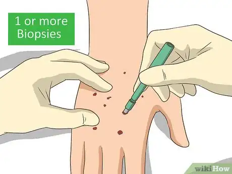 Image titled Diagnose Vasculitis Step 12