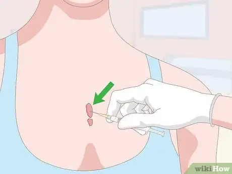 Image titled Get Rid of Scars Step 13