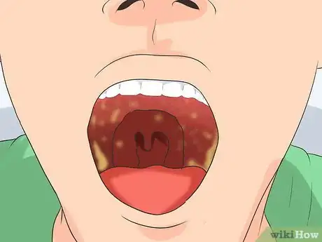 Image titled Recognize the Strep Throat Symptoms Step 2