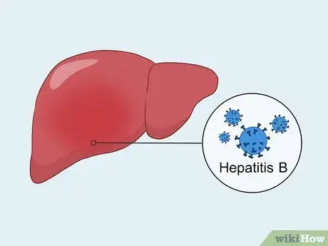 Image titled Treat Liver Fibrosis Step 5