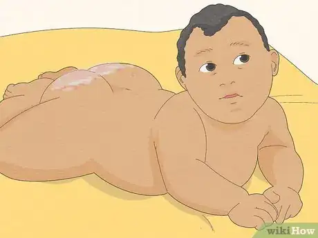 Image titled Use Coconut Oil for Diaper Rash Step 10