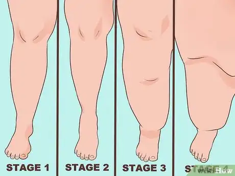 Image titled Diagnose Lipedema Step 2