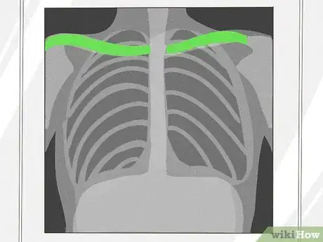 Image titled Know if a Chest X Ray Film Is Rotated Step 1