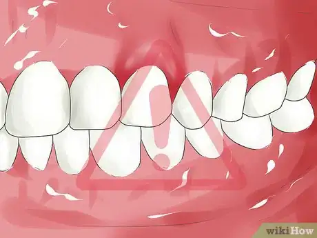 Image titled Know if You Have an Infected Tooth Step 4