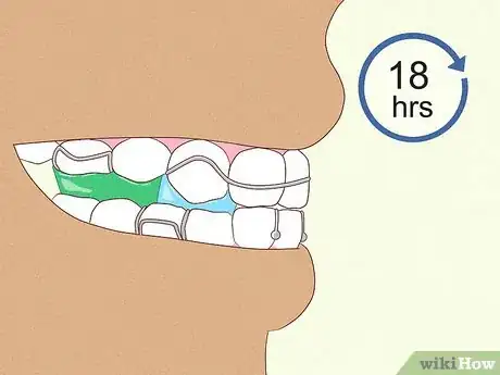 Image titled Cope with Twin Block Braces Step 9