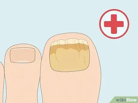 Image titled Cure Nail Fungus Step 21