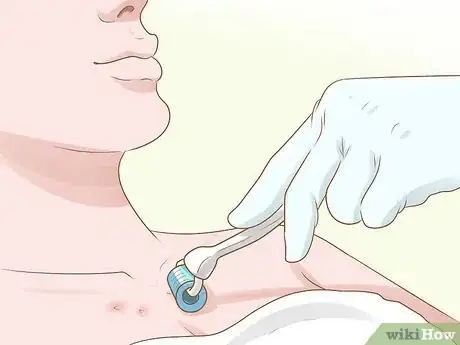 Image titled Get Rid of Acne Scars on Your Chest Step 2