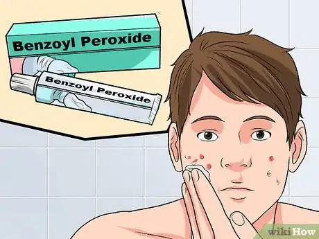 Image titled Use Tretinoin and Benzoyl Peroxide Concurrently Step 8