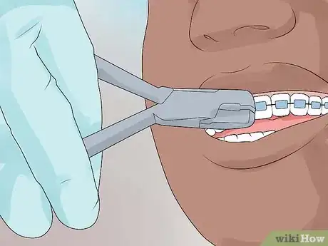 Image titled Prepare for Getting Braces Removed Step 6