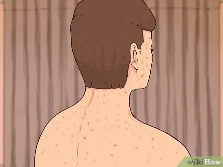 Image titled Perform Melanoma Skin Checks Step 15