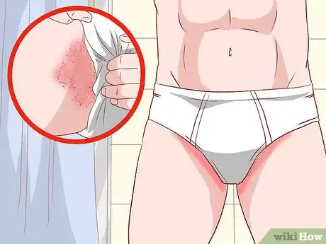 Image titled Prevent Skin Fungus Step 9