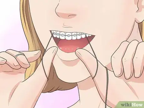 Image titled Make Your Braces Hurt Less Step 4