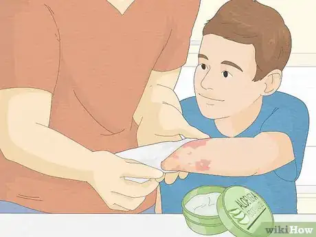 Image titled Use Aloe Vera to Treat Eczema Step 5