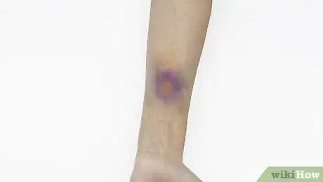 Image titled Make a Fake Bruise with Makeup Final