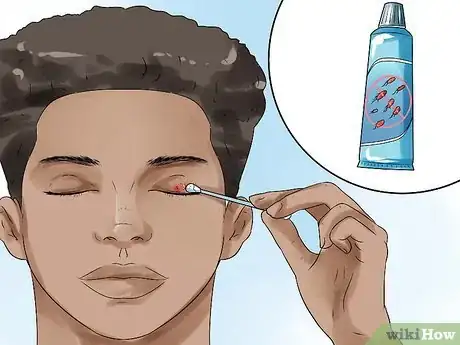 Image titled Get Rid of a Stye Step 4