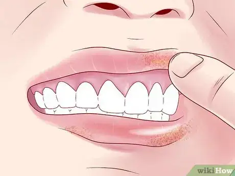 Image titled Tell if You Have Mouth Cancer Step 4