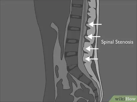 Image titled Read a Lumbar MRI Step 14