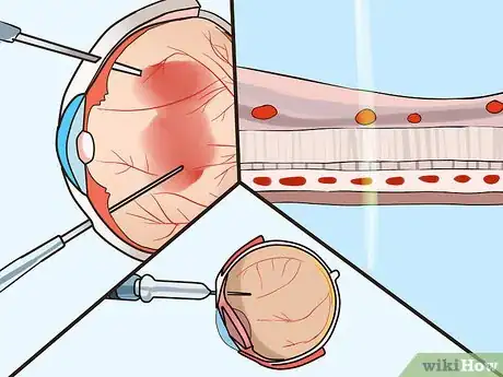 Image titled Treat Diabetic Retinopathy Step 4