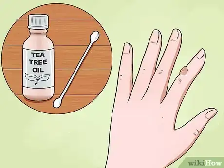 Image titled Get Rid of Warts on Hands Step 9