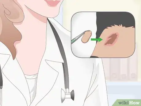 Image titled Get Rid of Scars Step 11