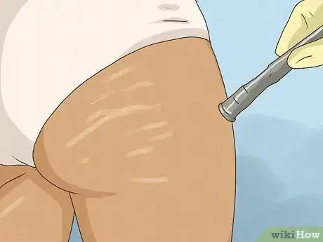 Image titled Get Rid of Stretch Marks Step 11