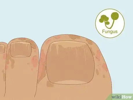 Image titled Fix a Split Toenail Step 10