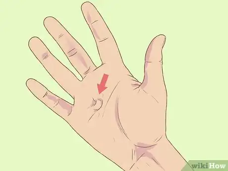 Image titled Diagnose Dupuytren's Contracture Step 1