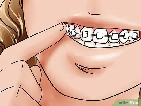 Image titled Apply Dental Wax on Braces Step 4