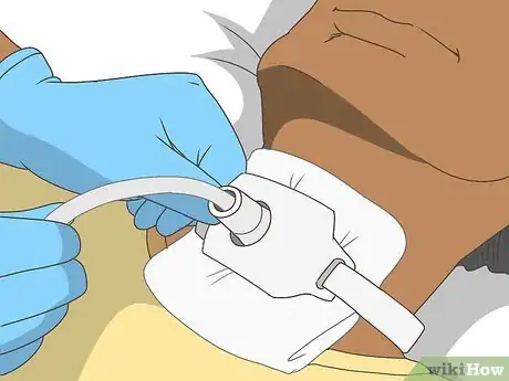 Image titled Perform Tracheostomy Care Step 11