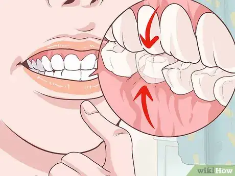 Image titled Fix a Lost Dental Crown Step 11