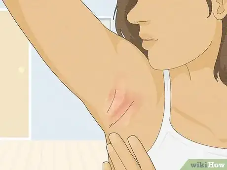 Image titled Heal Armpit Rash Step 2