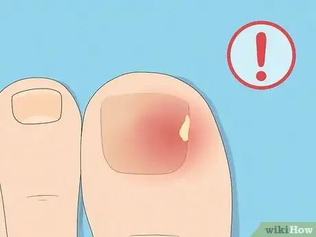 Image titled Remove a Dead Toenail Step 16