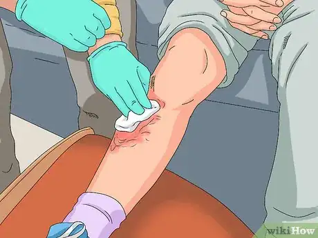 Image titled Determine if a Burn Is Infected Step 10