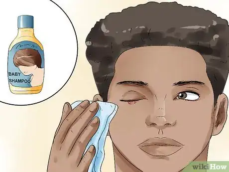 Image titled Get Rid of a Stye Step 8