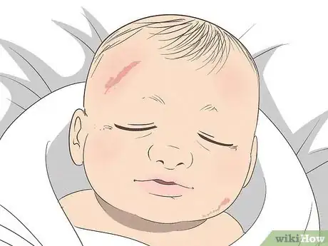 Image titled Know What to Expect on a Newborn's Skin Step 3