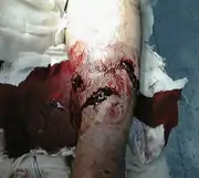 Gustilo type II open fracture