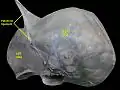 A cadaver liver seen from above, showing the falciform ligament at the top