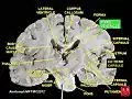 Third ventricle