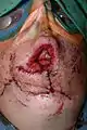 Patient immediately after closure of total lower lip reconstruction