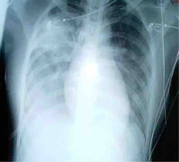 Medical importance of SARS